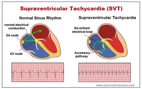 What Is Supraventricular Tachycardia Svt Svt Heart Cardiac Images And