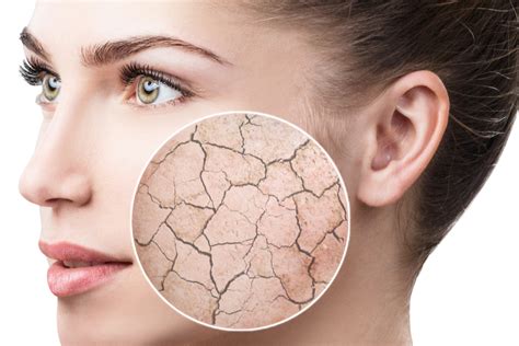 Dry Skin On Face Causes Treatments And Preventative Measures