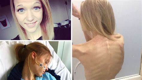 Thinspiration Selfies Almost Killed Me Anorexia Survivors Warning As Mirror Investigation