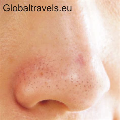 This usually clears up quickly. Acne Cause and Treatment: Very Simple Trick for Blackheads ...