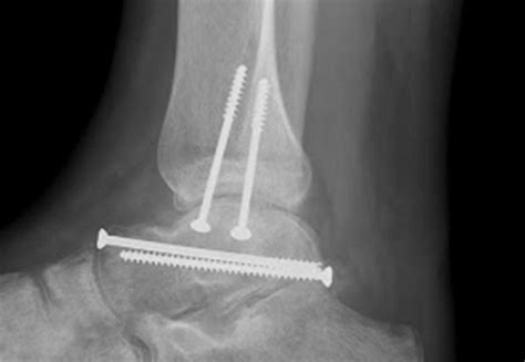 Talus Fractures Dr Warren