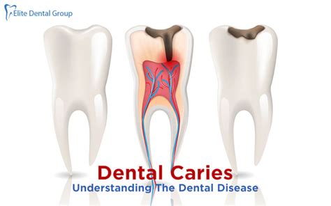 Dental Caries Causes Symptoms Types And Treatment