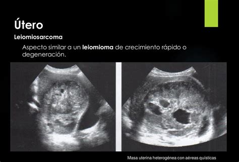Alteração Da Ecotextura Miometrial