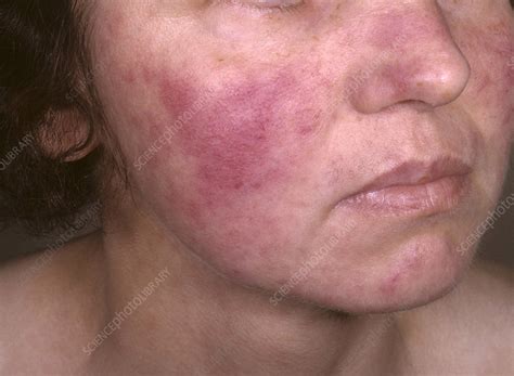 Systemic Lupus Erythematosus Stock Image C0384499 Science Photo