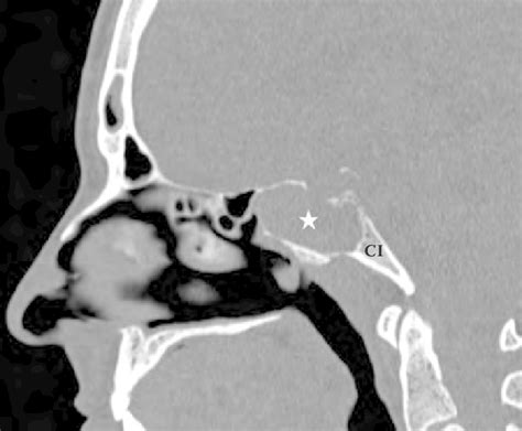 11 Sagittal Reformatted Computed Tomography Scan Shows A Soft Tissue