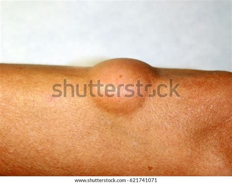 Lipoma On Elbow Arm Stock Photo Edit Now 621741071