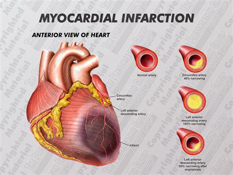 How Can You Identify The Old Myocardial Infarction On An Ecg Design Talk