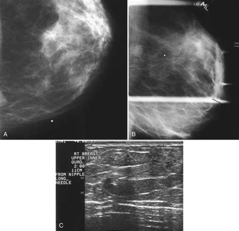 Mammographic And Ultrasound Guided Breast Biopsy Procedures Radiology Key