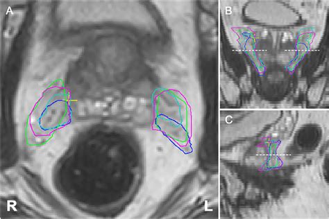Representative Case Of Contours Of The Neurovascular Bundles Prostate