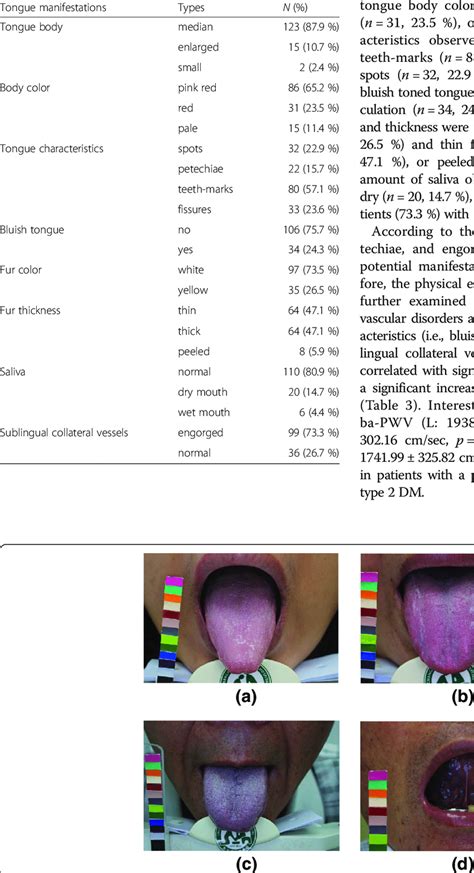 Tongue Manifestations Of Patients With Type 2 Diabetes Download Table