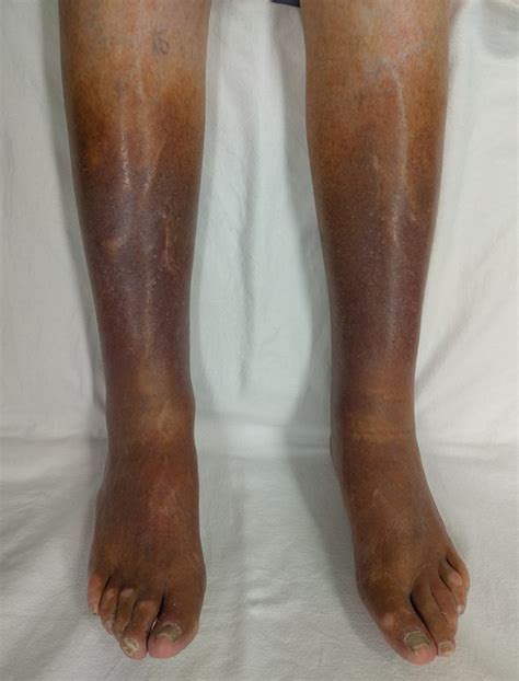Ways To Reverse The Symptoms Of Venous Insufficiency Cvm