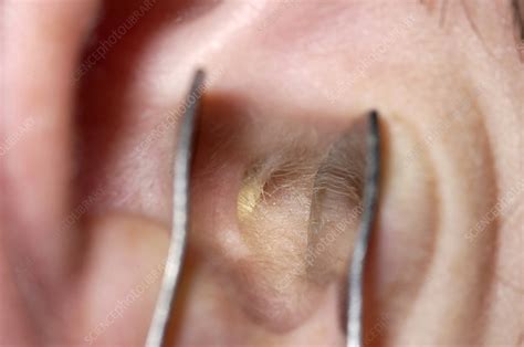 Foreign Body In Ear Stock Image M1570068 Science Photo Library