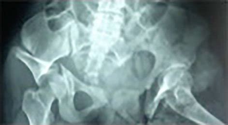 Pelvic Ap Radiograph Showing Bilateral Pelvic Fracture Marvin Tile C