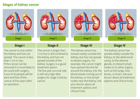 What Are The Different Kidney Cancer Stages Ikcc International