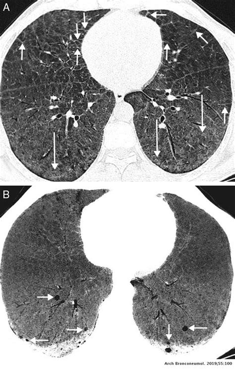 Niemann Pick Disease Type B A Rare Cause Of Lung Cysts Archivos De