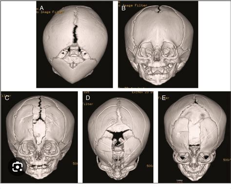 Ct Scans Of An Infants Skull Before And After Surgery To Open Up A