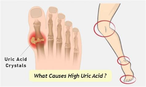 High Uric Acid Symptoms What Causes High Uric Acid Levels In The Body