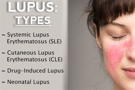 Types Of Lupus Disease Symptoms And Flare Ups Emedihealth