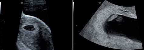 Early Pregnancy Scan What To Expect The Ultrasound Suitethe