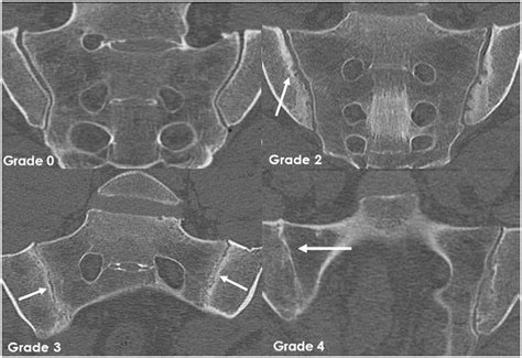 Radiography and abdominal CT compared with sacroiliac joint CT in the