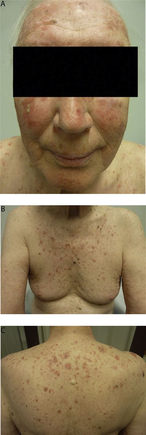 Figure 1 From Inflammation Of Actinic Keratoses After Docetaxel
