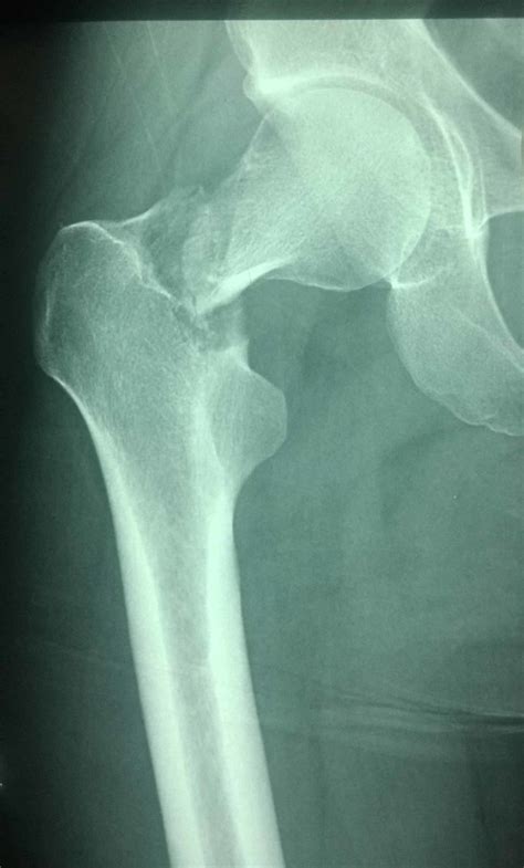 Femoral Head Fracture X Ray