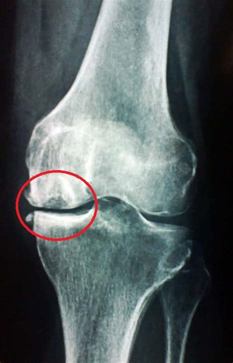 Некроз мыщелка бедренной. Кенига болезнь коленного сустава на рентгене. Рассекающий остеохондрит Кенига. Остеохондропатия Кенига. Рассекающий остеохондрит коленного рентген.