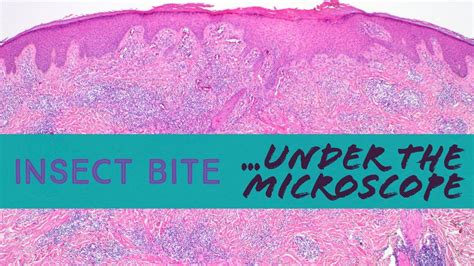 Bug Bite Under The Microscope Aka Arthropod Assault Patient Had Scabies Histology Pathology