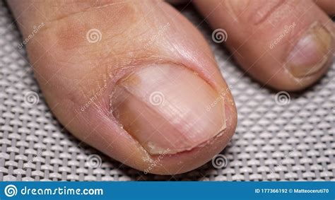Nail Infections Caused By Fungi Such As Onychomycosis Caused By