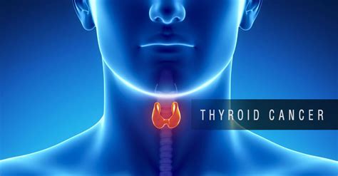 Thyroid Cancer Causes And Risk Factors