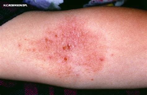 Severe And Predominantly Active Atopic Eczema In Adulthood And Long