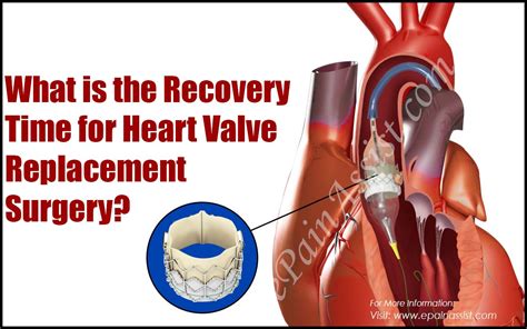 There is insufficient evidence to confirm. What is the Recovery Time for Heart Valve Replacement Surgery?
