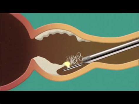 Anatomic Vaporization Of The Prostate Technique Youtube