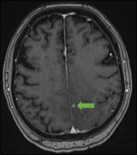 Figure 2c Axial Projection Of A Contrast Enhanced T1 Weighted Mri