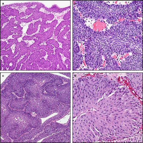 Inverted Papilloma And Inverted Papillary Urothelial Neoplasm Of Low