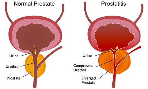 Prostatitis Acute Or Chronic Causes Symptoms Diagnosis And Treatment