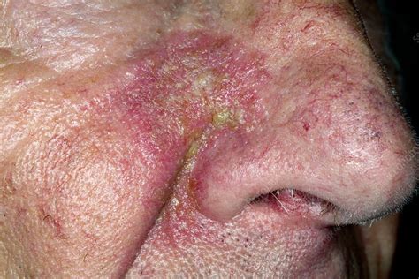 Seborrheic Dermatitis On The Nose Stock Image C021 3313 Science