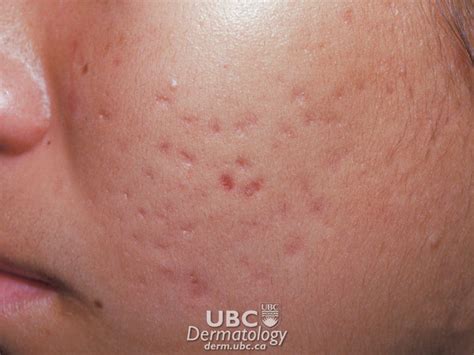 Cspa Overview What Is Acne