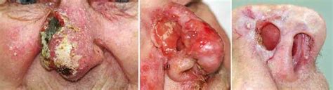 Figure Advanced Cutaneous Squamous Cell Carcinoma Of The Nose Before