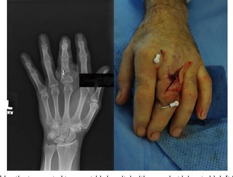 Figure 1 From Open Fractures Of The Hand With Soft Tissue Loss