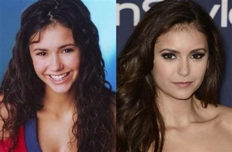 Nina Dobrev Before And After Plastic Surgery Celebrity Plastic