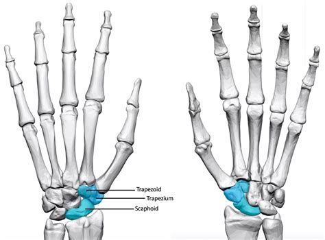 Tri Scaphoid Osteoarthritis Aberdeen Virtual Hand Clinic