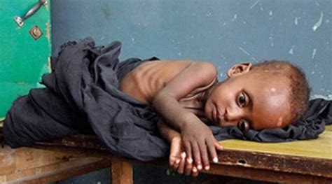 Mumbai Paper Clip Malnutrition Higher Among Children In Slums Of Mmr
