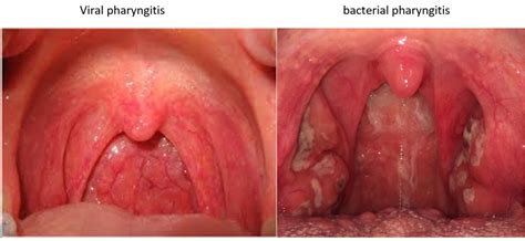 Sore Throat Causes Symptoms And Health Measures