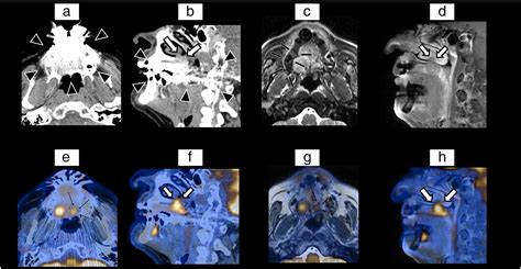 Petmr Versus Petct In The Initial Staging Of Head And Neck Cancer