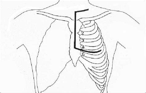 Trapdoor Incision Subclavian And Emergency Medicine Surgical