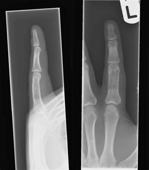 Ap And Lateral Radiographs Of The Left Index Finger There Is A Poorly
