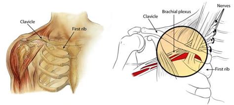 Erbs Palsy Brachial Plexus Birth Palsy Orthoinfo Aaos