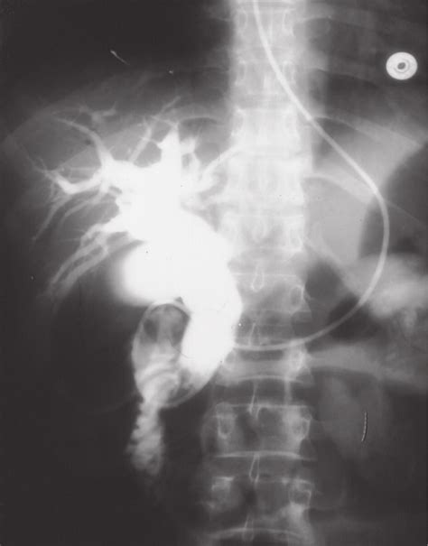 Ercp Showing Dilated Bile Ducts Without An Obstructive Cause Note The