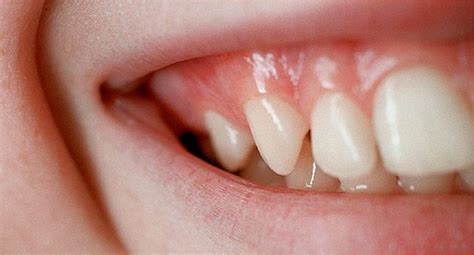 White Gums Around Teeth After Brushing Teethwalls